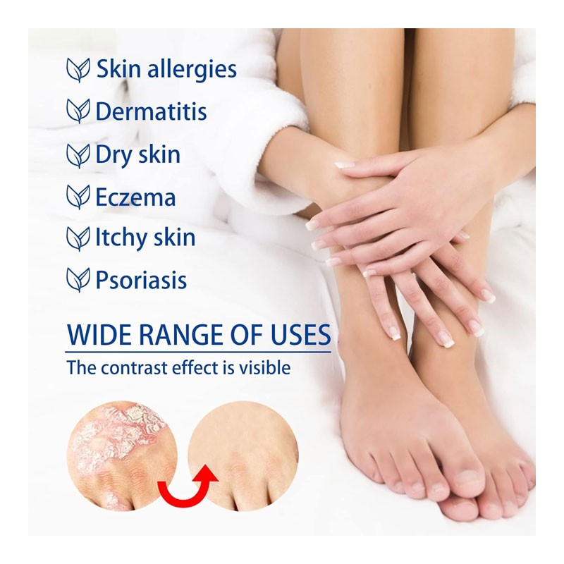 Southmoon Psoriasis Removal Ointment Eczema Best Anti Dermatitis, 20g-35261